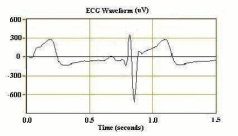 Figura 3 – sinal ECG do batimento cardíaco

