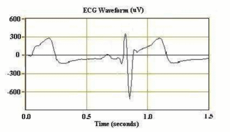 Figura 3 – sinal ECG do batimento cardíaco
Figura 3 – sinal ECG do batimento cardíaco
